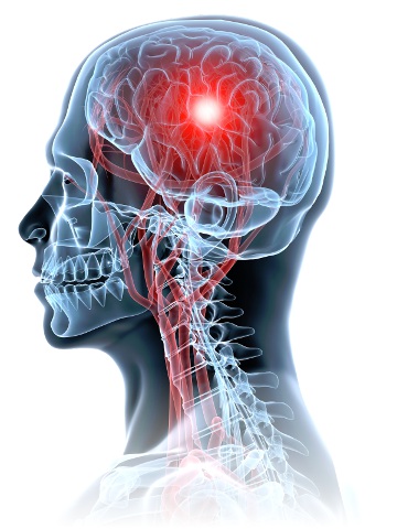 Hydrocéphalie Spina-Bifida Cerveau